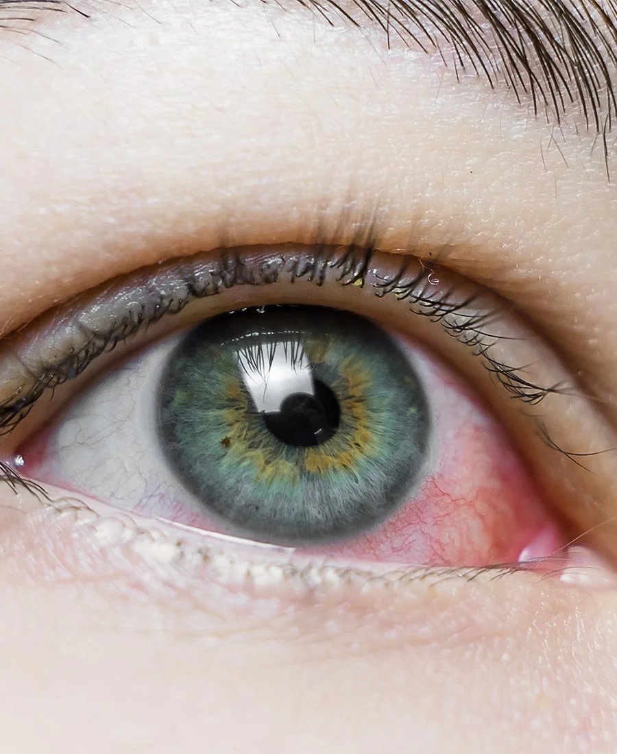 Red, irritated eye